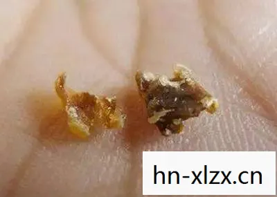 耳屎挖掘者2，探索耳朵深处的奥秘