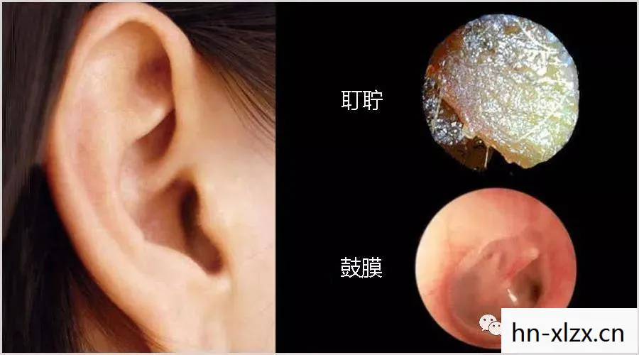 耳屎挖掘者2，探索耳朵深处的奥秘
